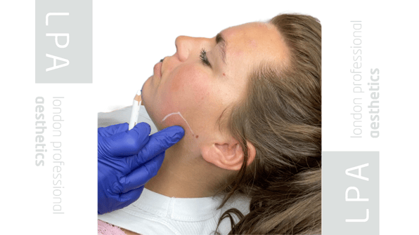 Masseter Botox in London