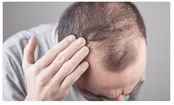 A man touching his hair to show how to solve hair loss problems.