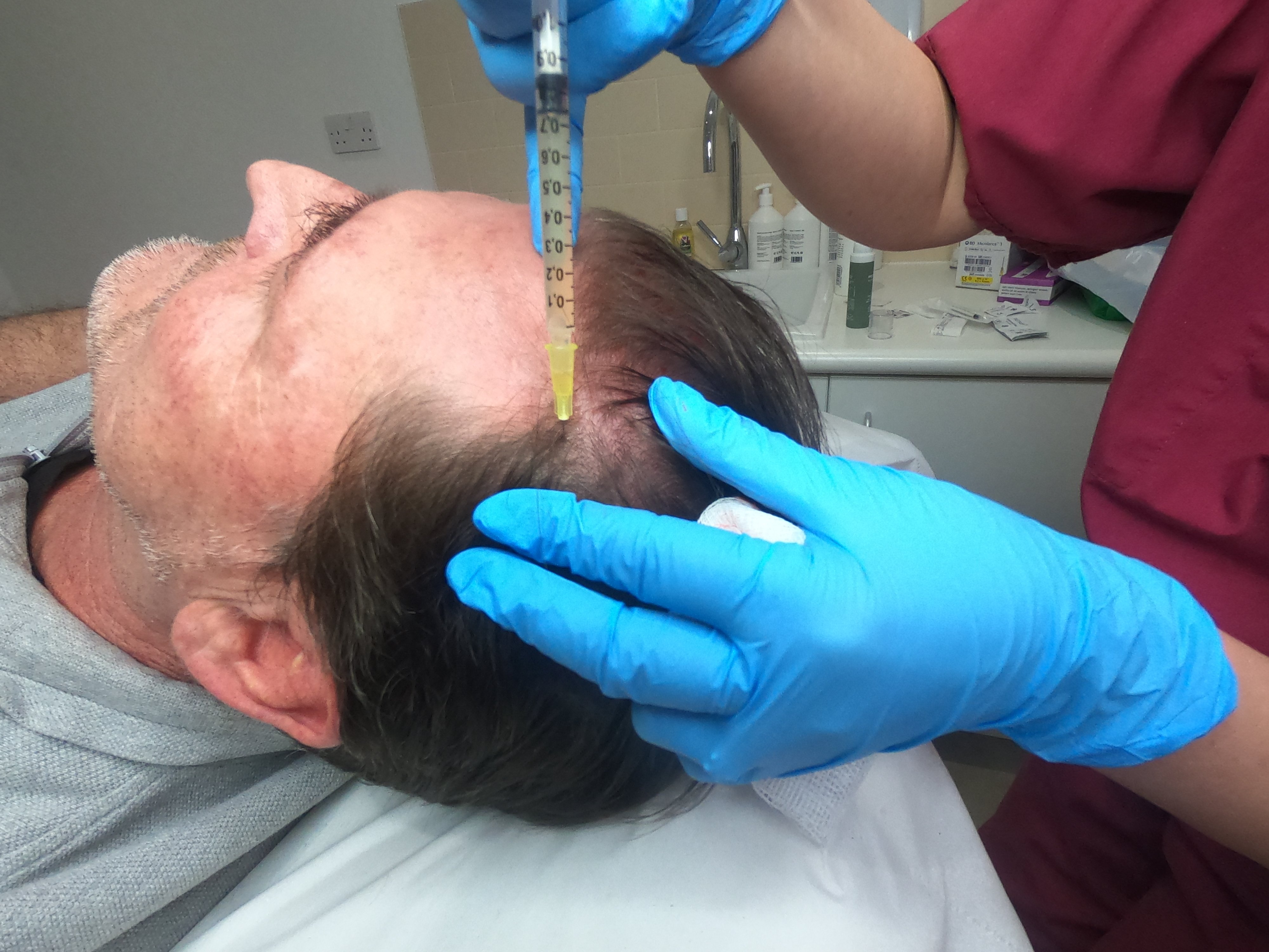 male hair treatment