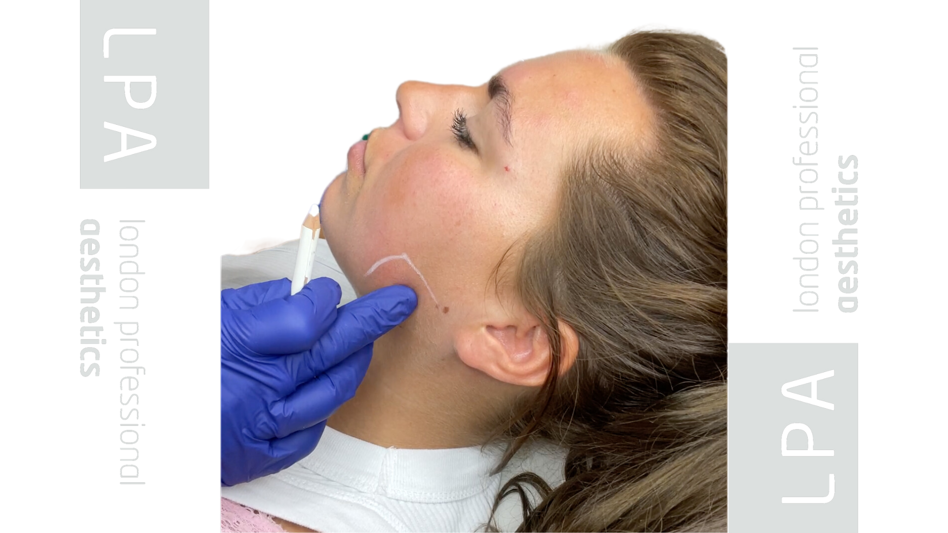 Masseter Botox in London